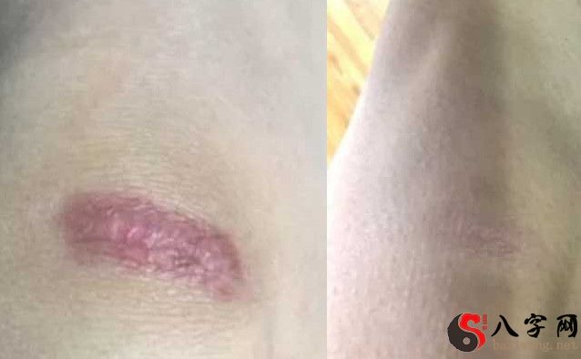 Dream of going to the hospital to get rid of scars